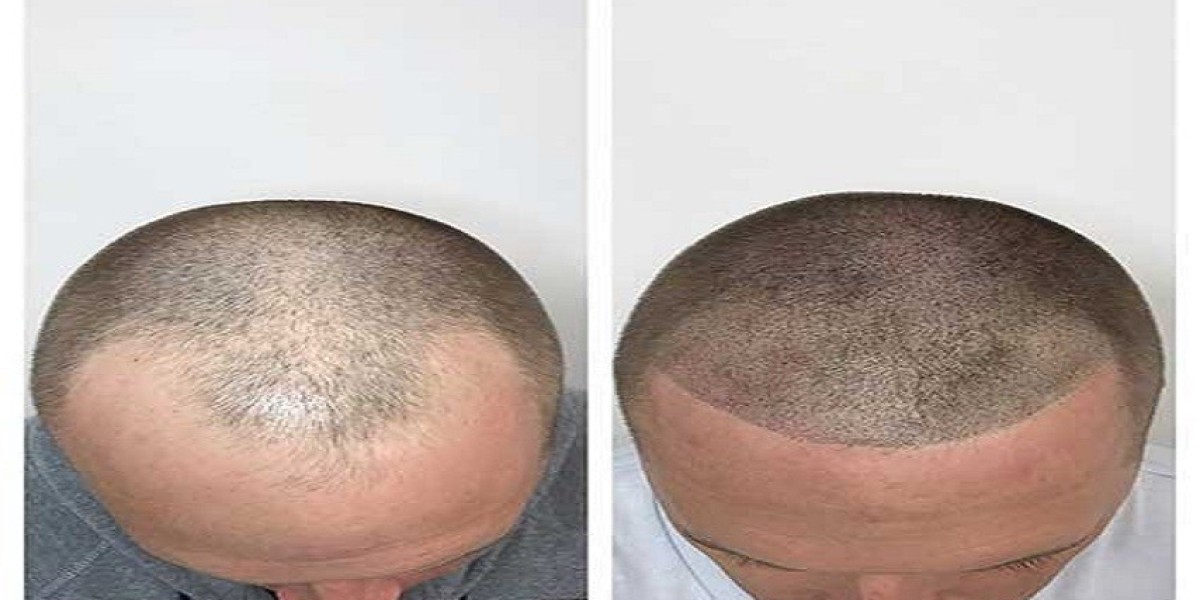 Flaky Scalp? Here’s How to Control Dandruff and Soothe Itching Naturally