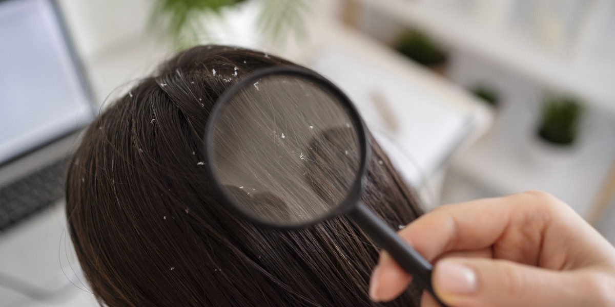 5 Most Common Reasons behind Dandruff and How a Defence Shampoo Can Assist