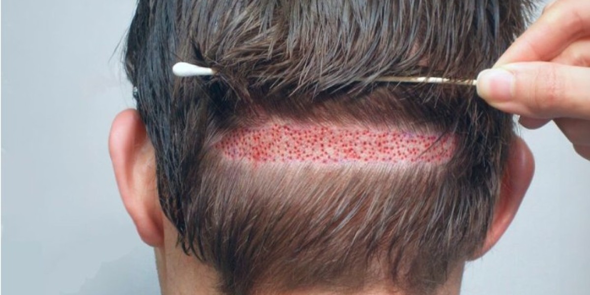 Is Hair Transplant in Pakistan Worth It? Cost vs. Results Explained